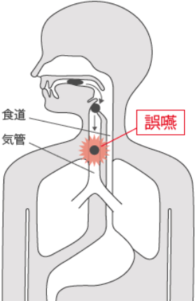 誤嚥したときの状態