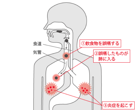 一般的な誤嚥性肺炎発症