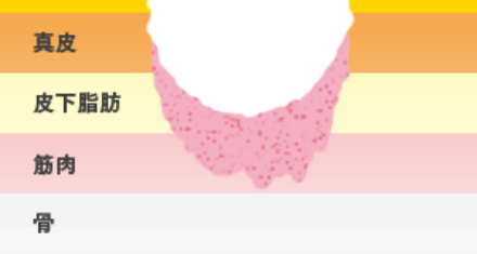 皮膚全層欠損で筋膜を越えない
